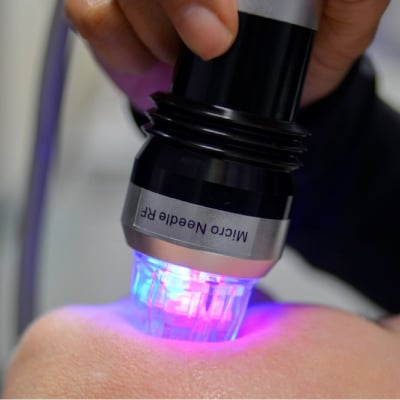 MICRONEEDLING 